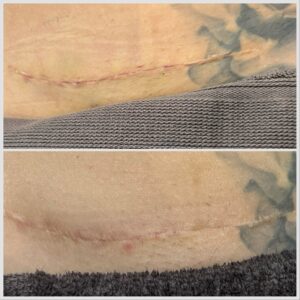 Post C-Section scar management 