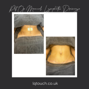 Before and After of a Post Op Manual Lymphatic Drainage Client