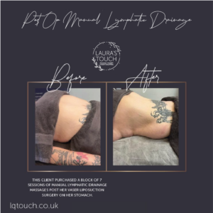 Client Transformation Post Lipo