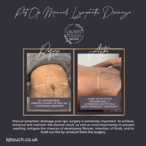 Manual Lymphatic Drainage for a client who developed an extreme case of Fibrosis and came to Laura's Touch for treatment.