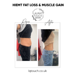 Before and After of a HIEMT Fat Loss and Muscle Gain client at Laura's Touch Bromley Clinic