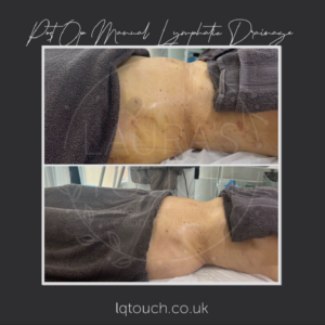 Post Op Manual Lymphatic Drainage Clien