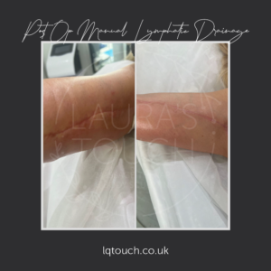 Post Op Manual Lymphatic Drainage