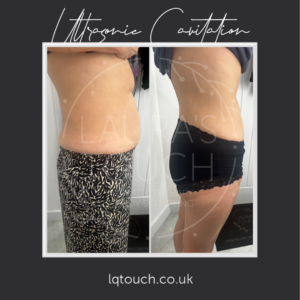 Ultrasonic cavitation at Laura's Touch