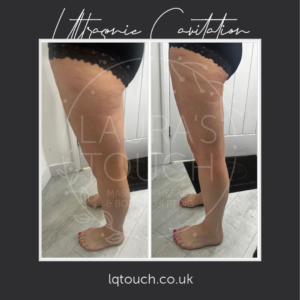 Ultrasonic cavitation at Laura's Touch