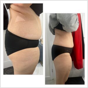 Before and After Ultrasonic Cavitation and Radio Frequency treatment on stomach and thighs