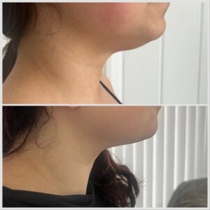 Lemon bottle fat dissolving injections small area chin