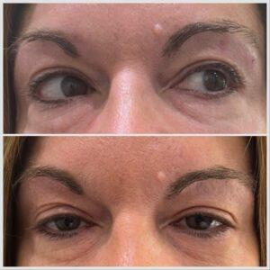 Before and After Facial Lymphatic drainage to address puffy under eyes