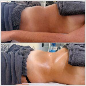 Before and after Detox and Debloat MLD treatment